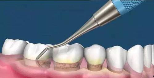 洗牙全过程视频,从准备到结束的全方位体验